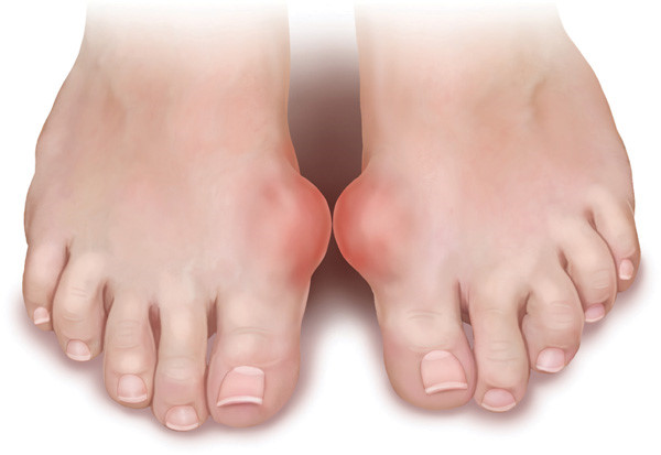 Công dụng trị gout thần kỳ từ nước Kangen Công dụng trị gout thần kỳ từ nước Kangen