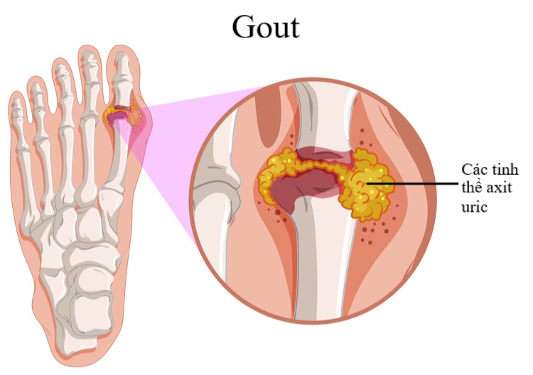 Công dụng trị gout thần kỳ từ nước Kangen