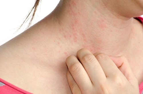 Nguyên nhân và cách phòng ngừa da dị ứng