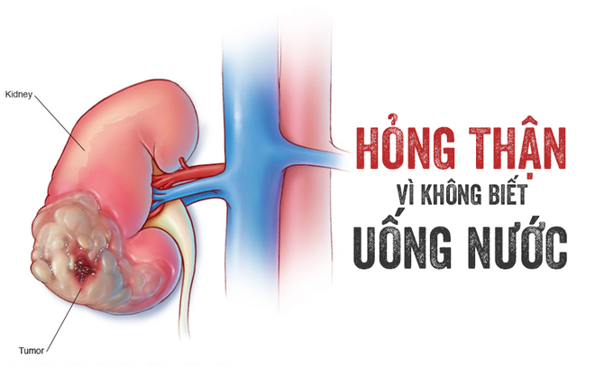 Những sai lầm trong ăn uống gây sỏi thận và cách cải thiện