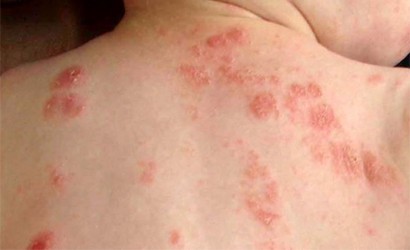 Nước Kangen điều trị bệnh viêm da Nước Kangen điều trị bệnh viêm da