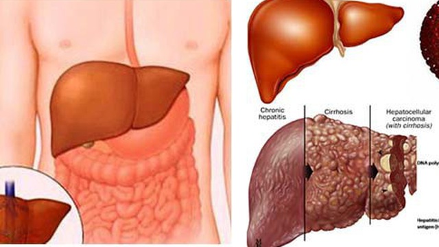 Tính nguy hiểm của bệnh gan và giải pháp phòng ngừa